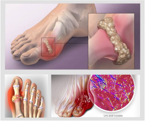 Bệnh gút – Nỗi lo của nhiều nam giới!